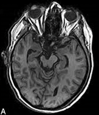 <p>A 67-year-old male presents to the office for follow up after suffering a stroke 2-months previous. Physical examination reveals his pupils are equal round and reactive to light and accommodation; all extra-ocular movements are intact. He has a Babinski sign on the left. He can wrinkle his forehead symmetrically but cannot smile on the left. Sensory testing is not performed at this time. An imaging study (administered 2-days ago) reveals the result shown in the accompanying image.</p><p>1. What tracts are degenerated in the image?</p><p>2. The infarct is in what vascular territory? (3 acceptable answers, give me 1).</p>