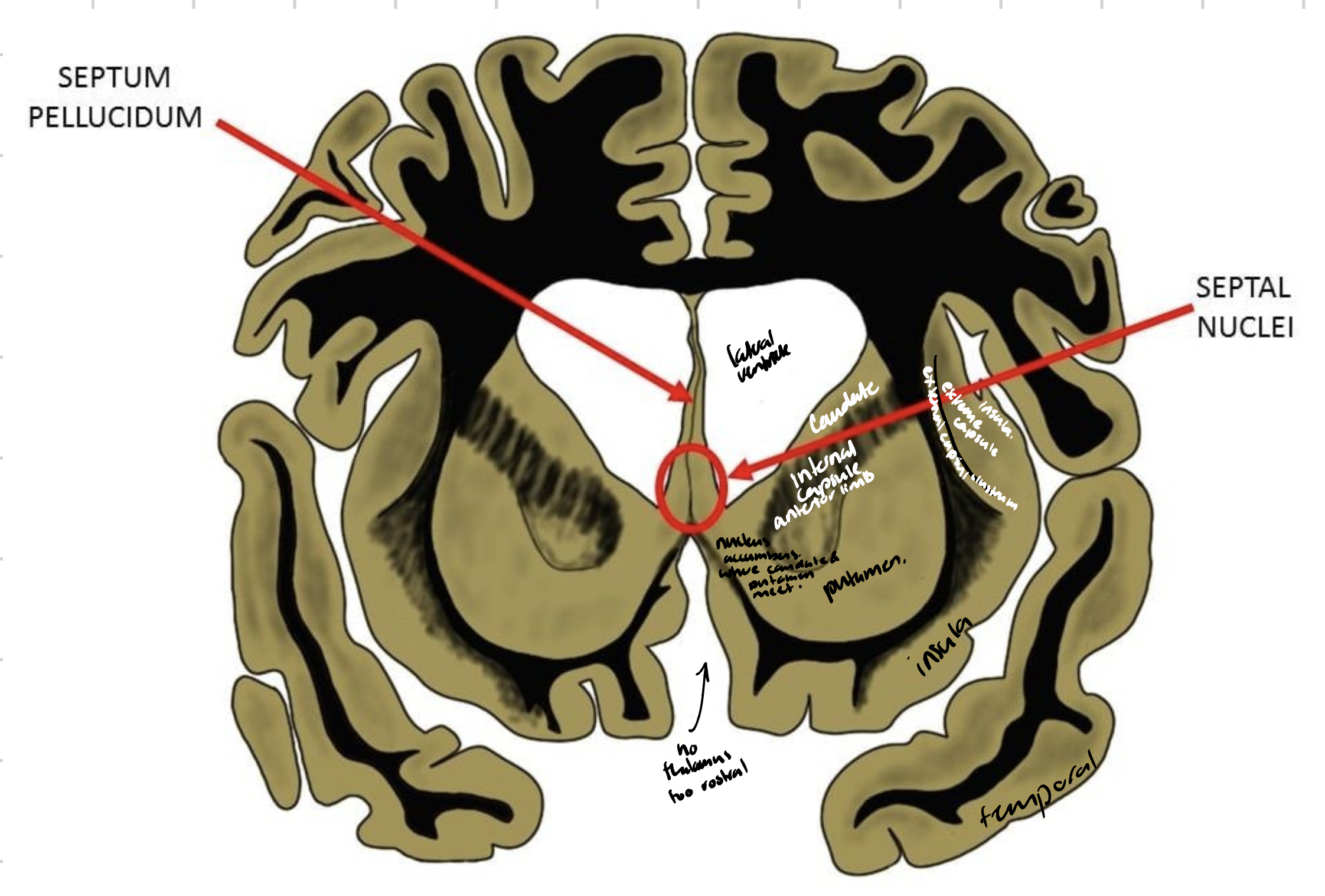 <ul><li><p>Head and tail of the caudate nucleus</p></li><li><p>Globus pallidus </p></li><li><p>Putamen </p></li><li><p>External capsule </p></li><li><p>Claustrum </p></li><li><p>Extreme capsule </p></li><li><p>Body and splenium of corpus callosum </p></li><li><p>Anterior and posterior horns of lateral ventricles </p></li><li><p>Choroid plexus </p></li><li><p>Septum pellucidum </p></li><li><p>Fornix </p></li><li><p>Insula </p></li><li><p>Lateral fissure </p></li></ul><p></p>