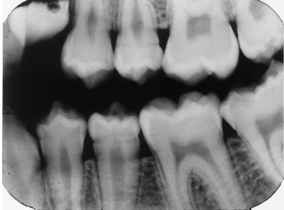 <p>Note the occlusal anatomy of the occlusal surface of the mandibular 2nd molar that has just erupted. Now look at the maxillary 2nd premolar and lower premolars. What is your assessment of these teeth?</p><p> </p><p>enamel hypoplasia</p><p> </p><p>rampant caries</p><p> </p><p>dentin dysplasia</p><p> </p><p>Don't look at me, I don't diagnose.</p>