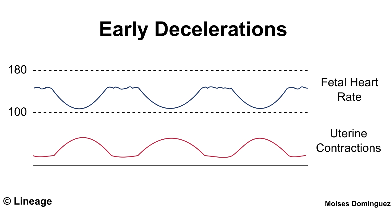 <p><strong>Define early decelerations</strong></p>
