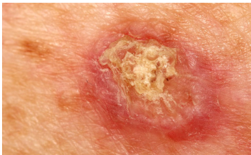 <p>What is a squamous cell carcinoma?</p>