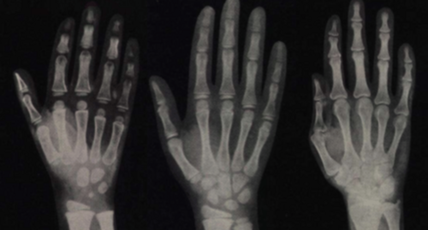 <p>Bone lengthening ceases; bone of epiphysis and diaphysis fuses</p>