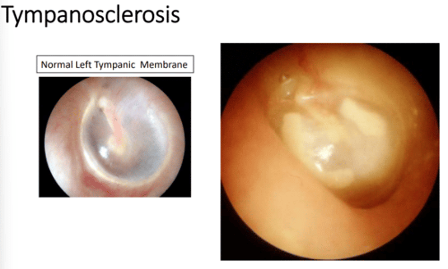 <p>d) Tympanosclerosis </p>