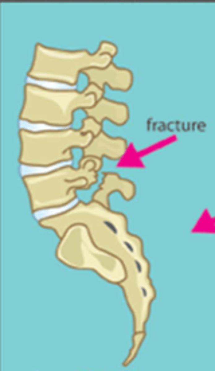 <p>fracture of pars interarticularis</p>
