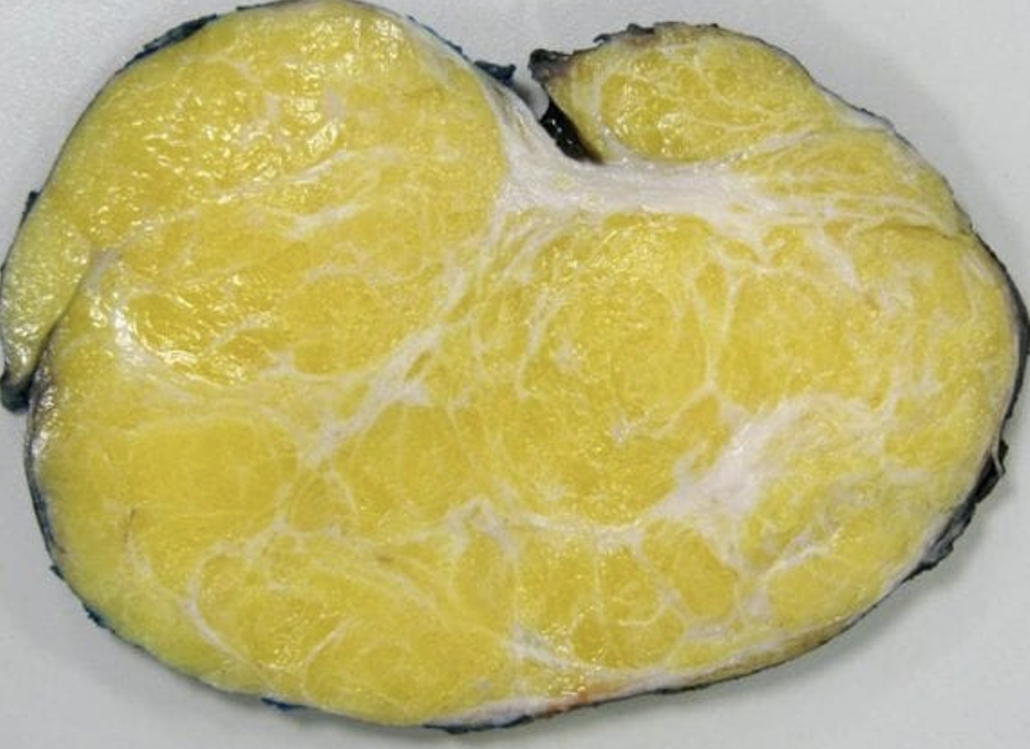 <p><span><span>Describe the gross appearance.</span></span></p><p style="text-align: left;"><span><span>What is the cell of origin?</span></span></p><p style="text-align: left;"><span><span>What is the diagnosis?</span></span></p><p style="text-align: left;"><span><span>What is the malignant counterpart called?</span></span></p>