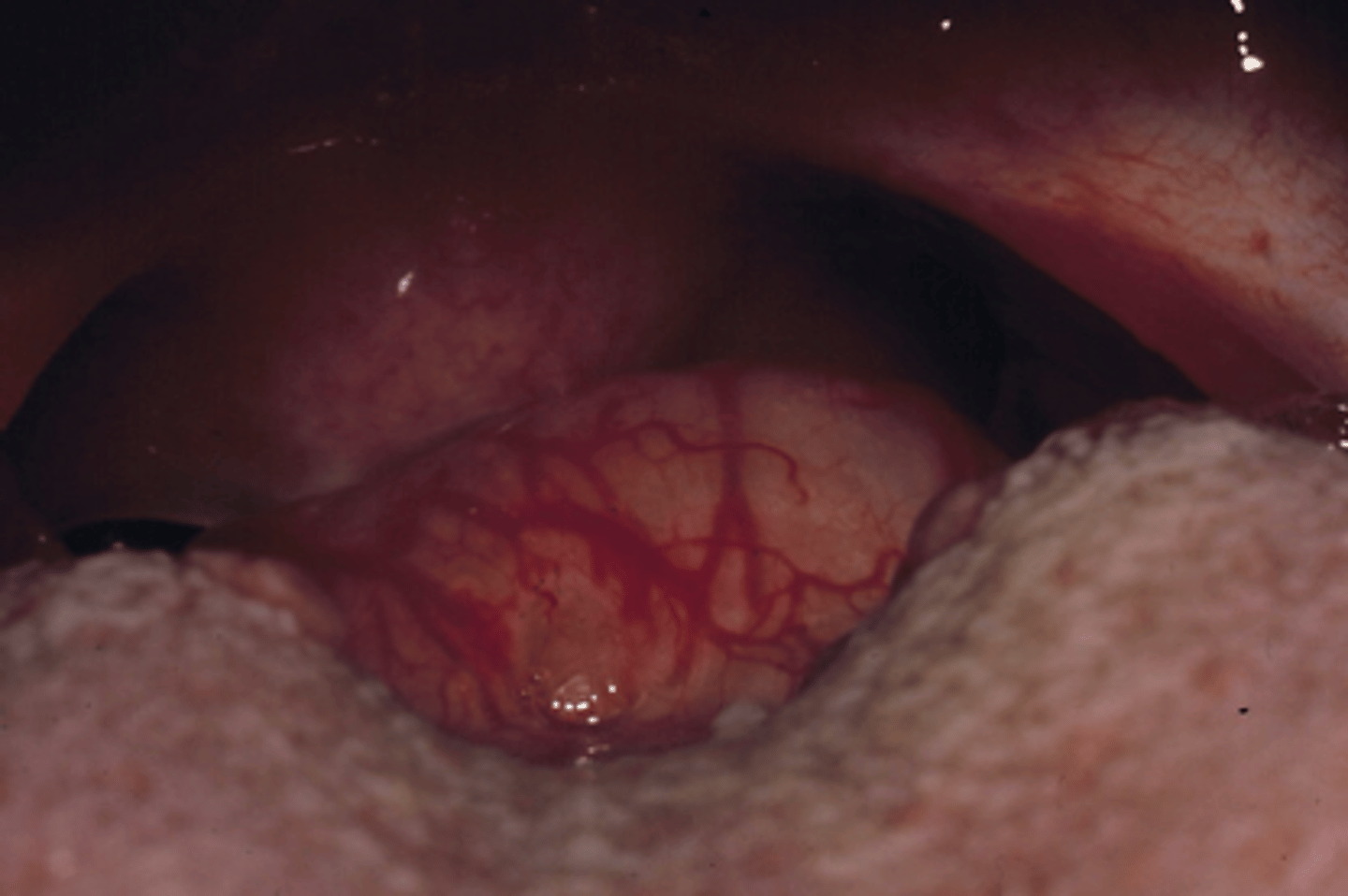 <p>lingual thyroid</p>