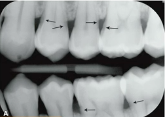 <p>what are these lesions </p>