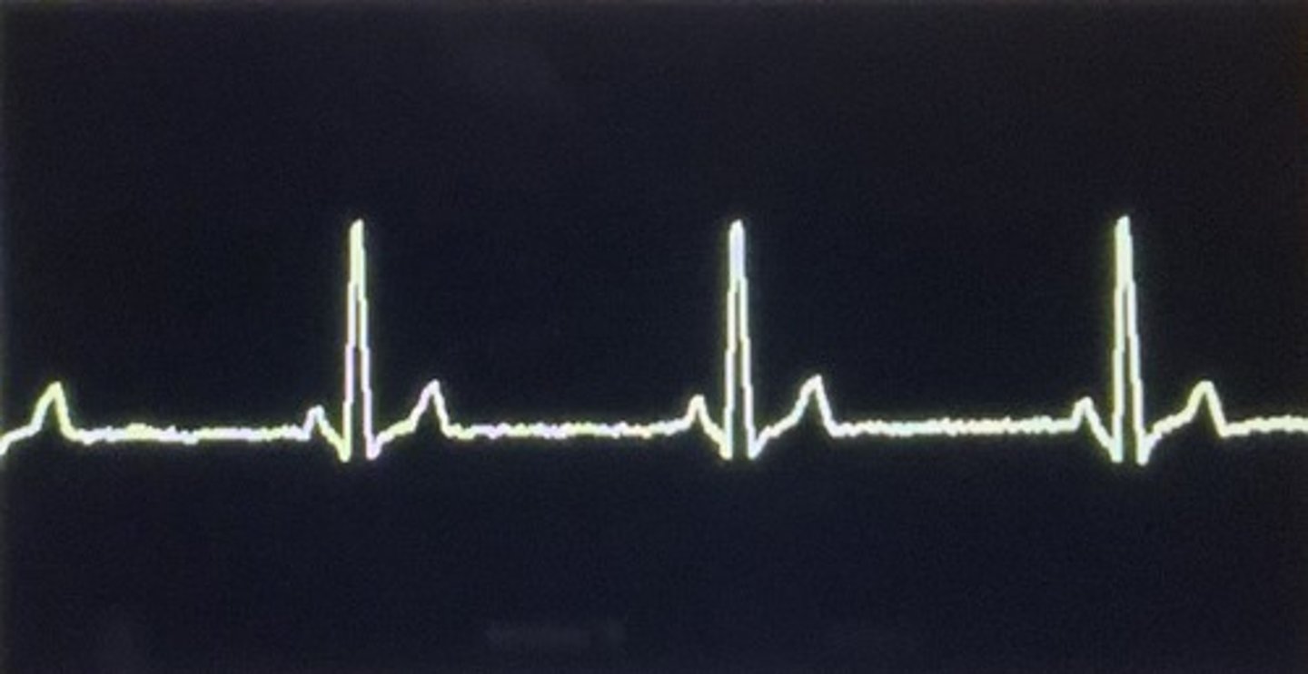 <p>Sinus bradycardia</p>