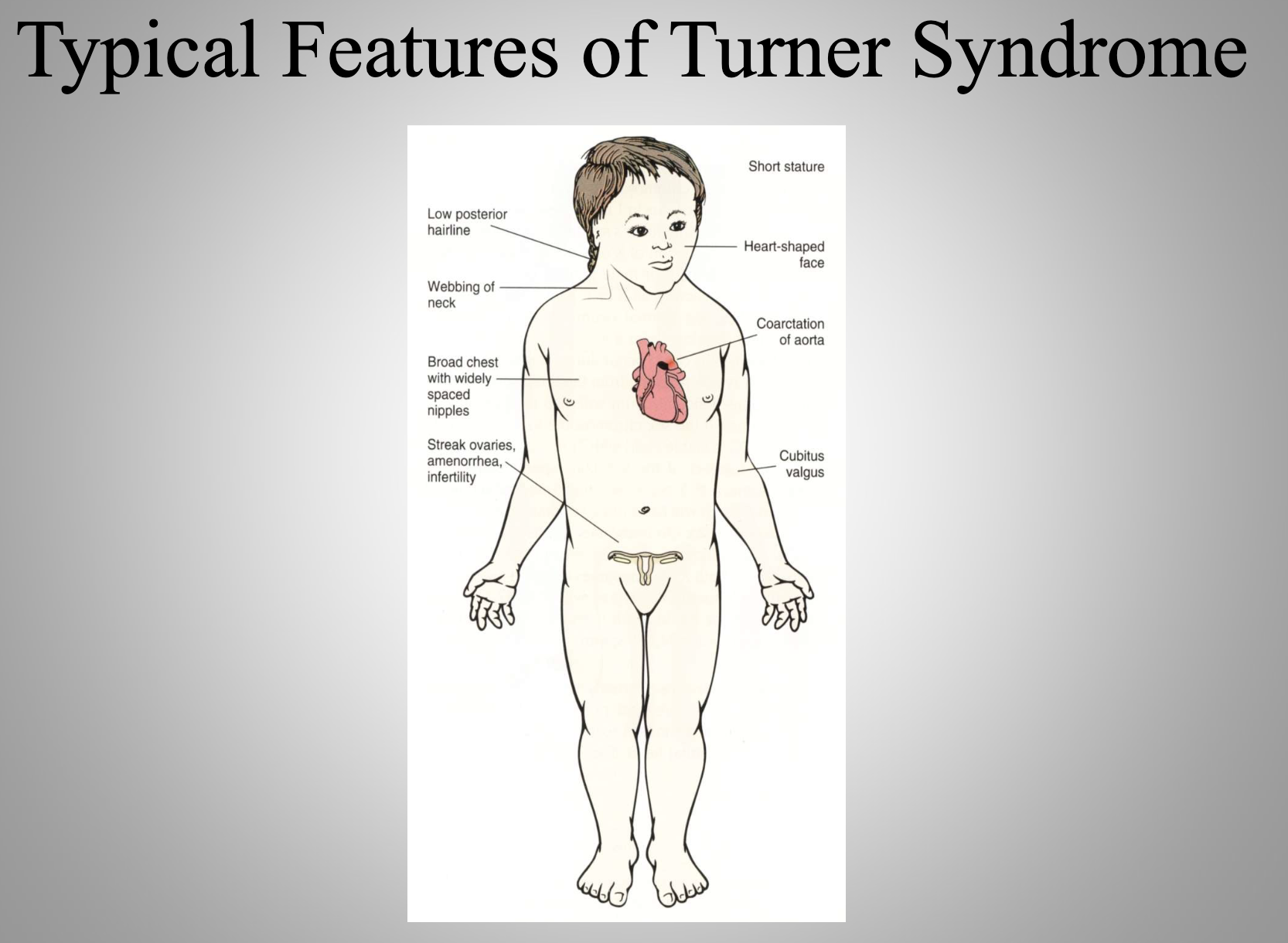 <p>Turner Syndrome (XO)</p>