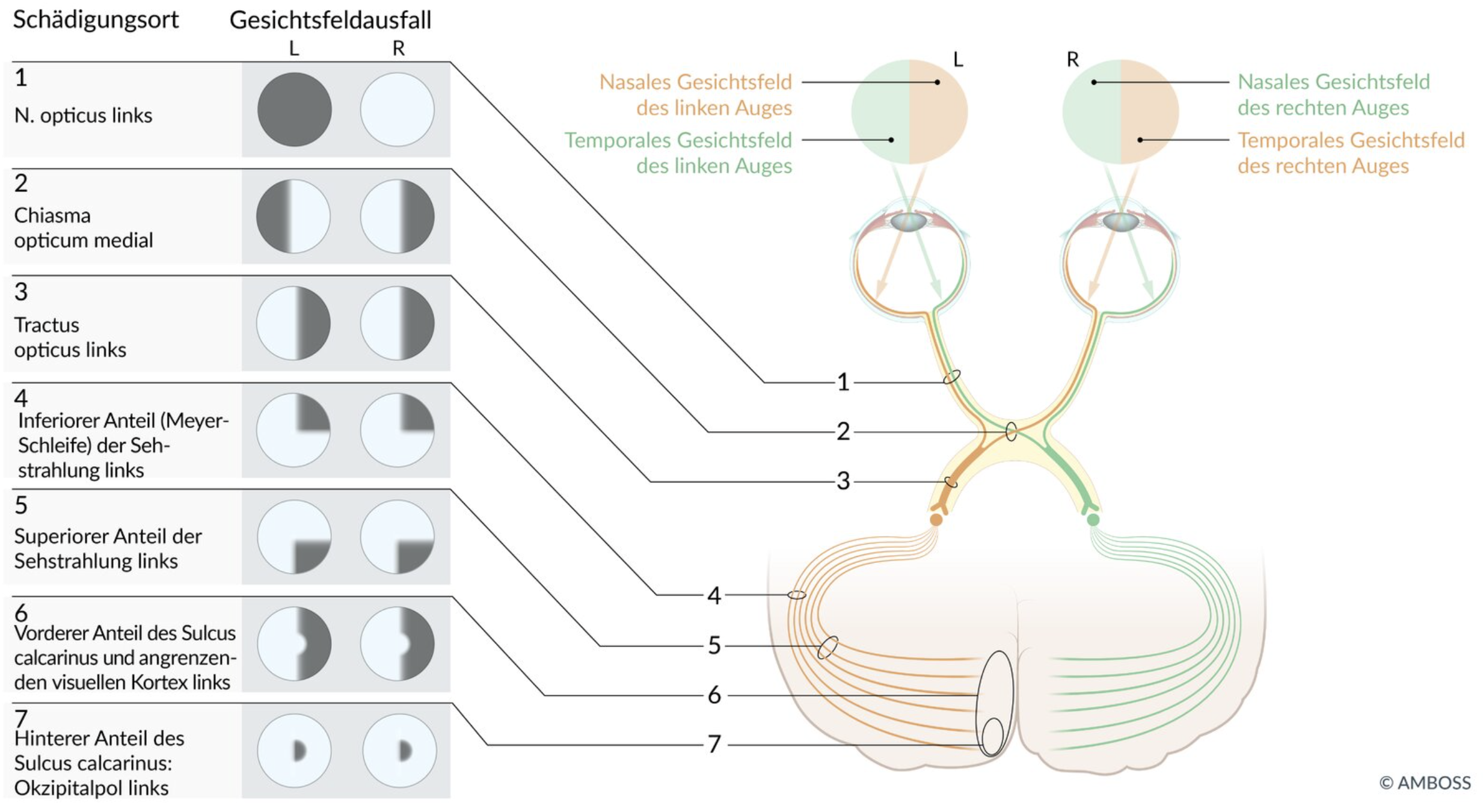 <p>D. Left cerebral cortex above the calcarine sulcus</p>