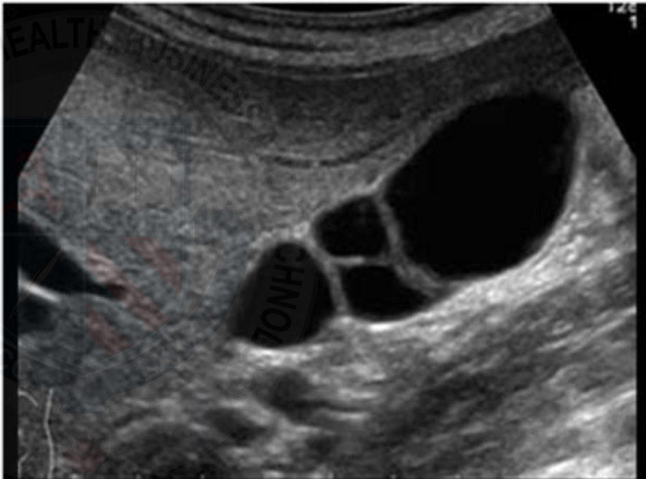 <p>Lumen of gallbladder fails at being completely open </p><p>Results in strands of tissue crossing through the lumen </p>