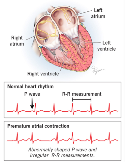 <p><strong>early</strong>, <strong>extra heartbeats</strong> originating in the atria</p><ul><li><p>ekg characteristics: early P wave may look different from the normal P wave</p></li></ul><p></p>