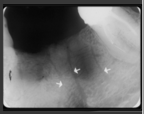 <p>They are thin radiolucent bands that can be seen in the sinus or in bone.</p>