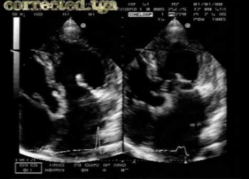 <p>Pre op findings of CC-TGA</p>