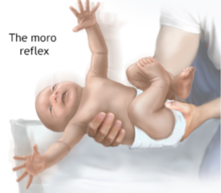 <p><strong>Neonatal Infant Reflex: </strong>Moro (Integration: ~4-6 mo)</p>