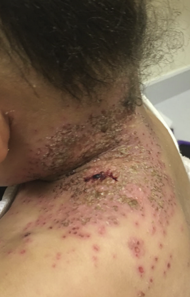 <p>2F, 4 days ago developed vesicular rash on left side of neck that spread to upper back. given tmp-sfx but now its erosions covered with crusts. tender cervical lns palpated. </p>