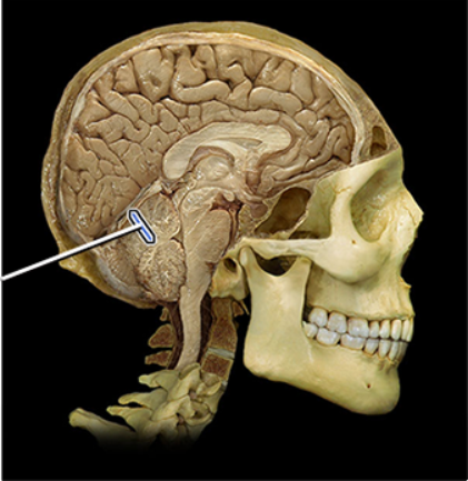 <p><span><span>Primary fissure of cerebellum</span></span></p>