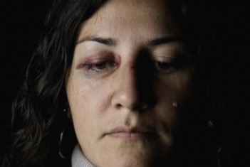 <ul><li><p>pain? does the bruising hurt?</p></li><li><p>how did this happen?</p><ul><li><p>who is our audience? are there family members of friends in the environment?</p></li><li><p>does the patient report match the pattern of injury</p></li></ul></li><li><p>when did this happen?</p></li><li><p>what makes it better or worse?</p></li><li><p>any vision changes?</p></li><li><p>double vision, blurry vision?</p></li><li><p>any nose bleeds?</p></li><li><p>numbness or tingling?</p></li></ul><p></p>