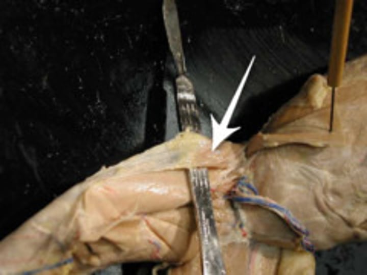 <p>connective tissue, silver-whit tendon that connects with tensor fasciae latae</p>