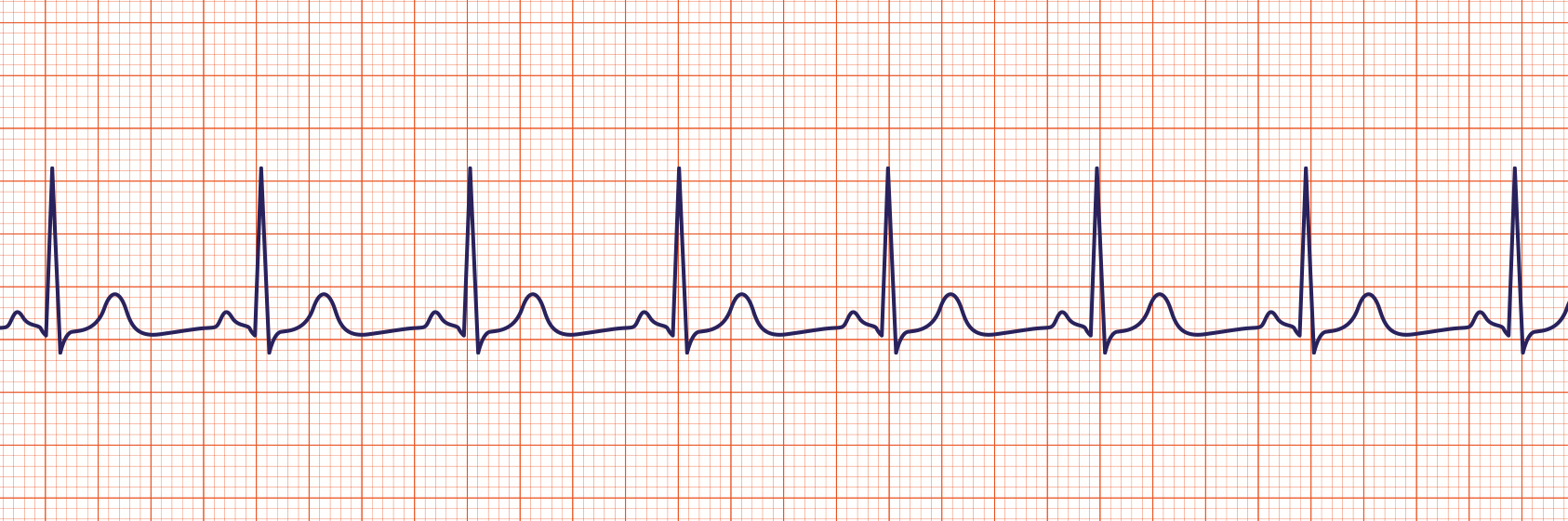 <p><span>A sinus rhythm is regular with normal P, Q-R-S, T deflections and intervals. </span></p><p><span>Rate = 60-100 at rest.</span></p>