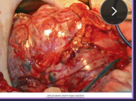 <p><span>Renal Neoplasia</span></p>