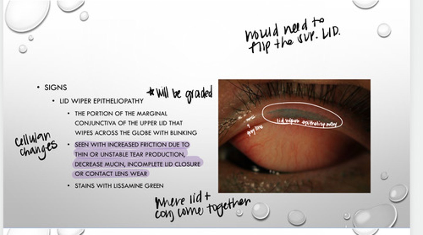 <p>What is lid wiper epitheliopathy seen with?</p>