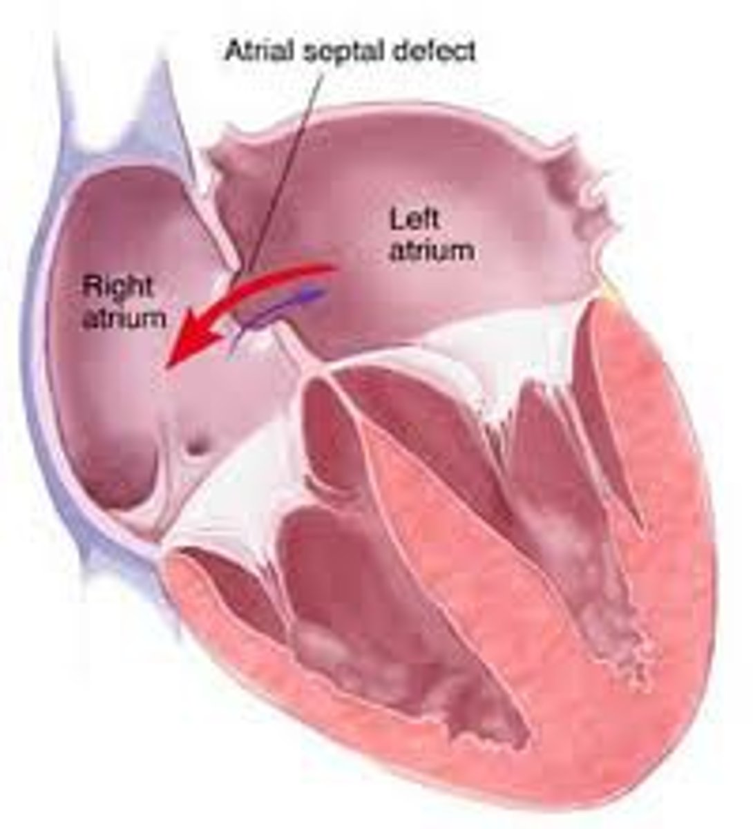 <p>Non-cyanotic congenital heart condition where there is an abnormal defect in the wall between the two atria (L → R blood shunt)</p>