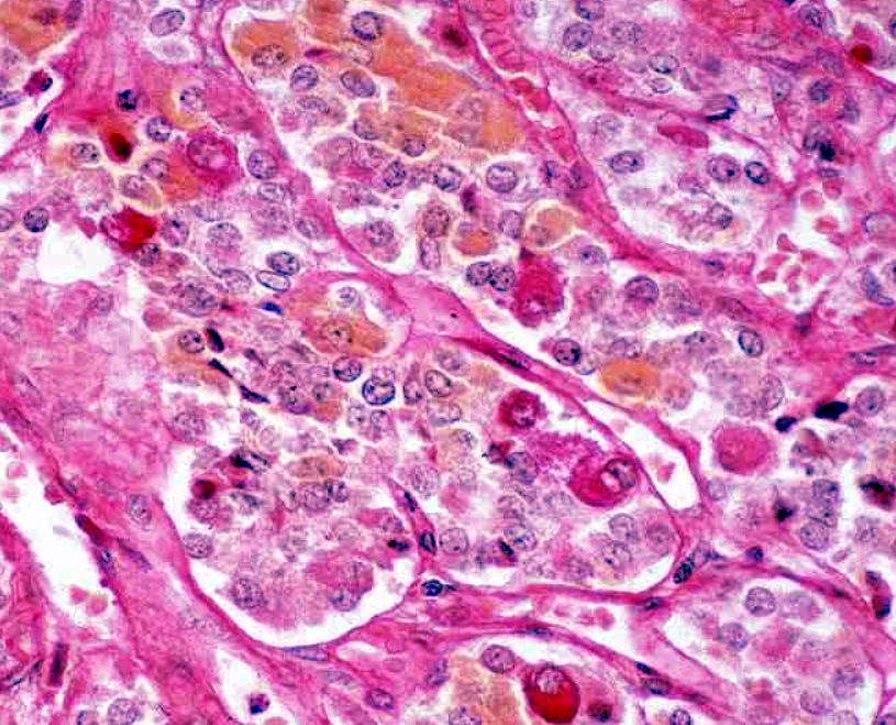 <p>Observe the histological pattern of this specimen and select the correct identification from the list.</p><p>This specimen was subject to the PAS histochemical reaction.</p><p>a) adrenal gland</p><p>b) thyroid gland</p><p>c) pituitary gland</p><p>d) parathyroid gland</p><p>e) pancreas</p>