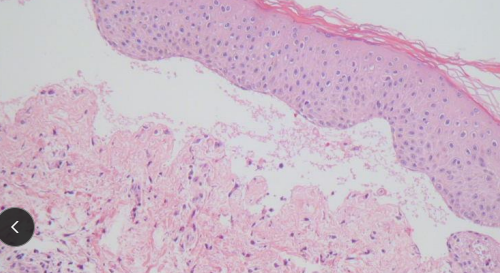 <ul><li><p>Subepidermal blistering</p></li><li><p><span style="color: rgb(136, 136, 136);"><strong>Et:</strong></span> Rare, <span style="color: red;"><strong><u>subepidermal Ab target → Type VII collagen</u></strong></span></p></li><li><p><span style="color: rgb(136, 136, 136);"><strong>Sig:</strong> </span><strong><u>Lesions develop shortly after birth</u></strong></p></li><li><p><span style="color: rgb(136, 136, 136);"><strong>Cs:</strong> </span>Vesicles, bullae, erosions, ulcers</p><ul><li><p>Footpads, oral, bony prominences → <u>due to friction</u></p></li></ul></li><li><p><span style="color: rgb(136, 136, 136);"><strong>Dt:</strong></span><strong> <u>biopsy (subepidermal clefting, min inflam!!), IF, EM, immunoblot, collagen VII ELISA</u></strong></p></li><li><p><span style="color: rgb(136, 136, 136);"><strong>Tx: NO specific TX!, </strong></span>symptomatic, <u>avoid trauma</u>, antibiotics, should not be bred</p></li></ul><p></p>