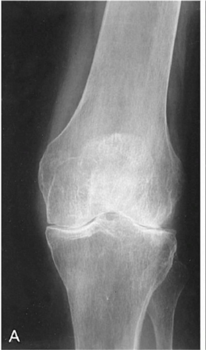 <p>_____ loss of joint space (inflammatory)</p>