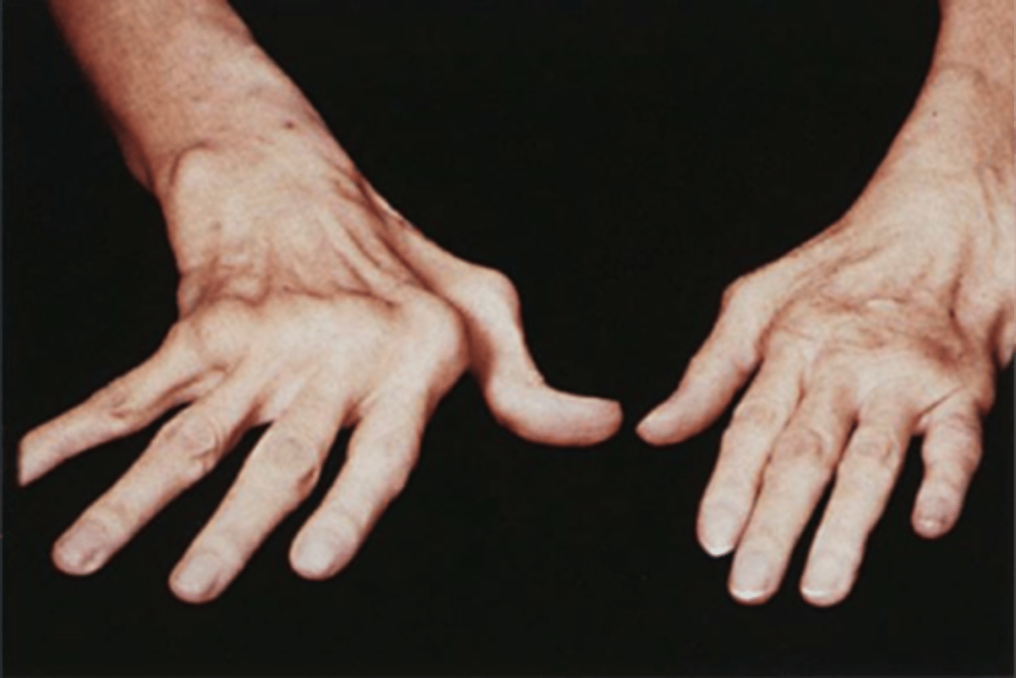 <p>Clinical manifestation of rheumatoid arthritis; ulnar deviation of the fingers at the metacarpophalangeal joints</p>