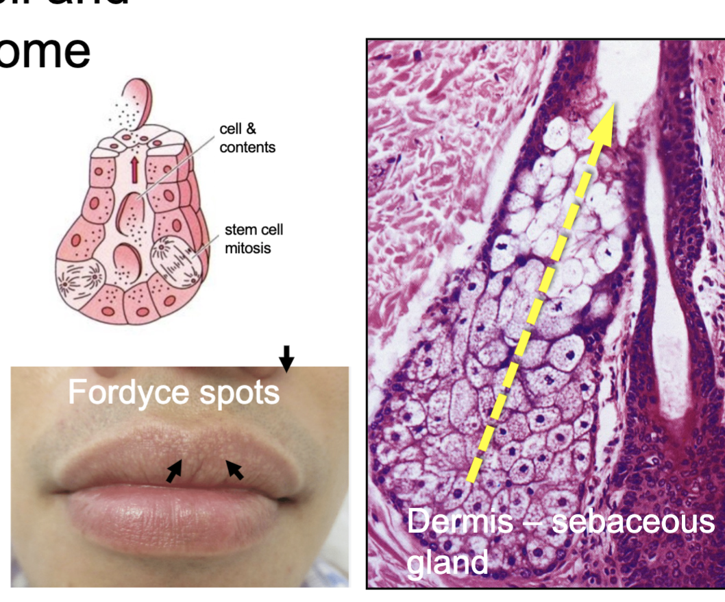 <p>Fordyce spots </p><p>sebaceous gland</p>