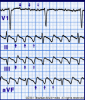 <p>If you see the following on an EKG, what arrhythmia is the heart in?</p><ul><li><p>saw-tooth</p></li><li><p>shaped P-waves</p></li></ul><p></p>