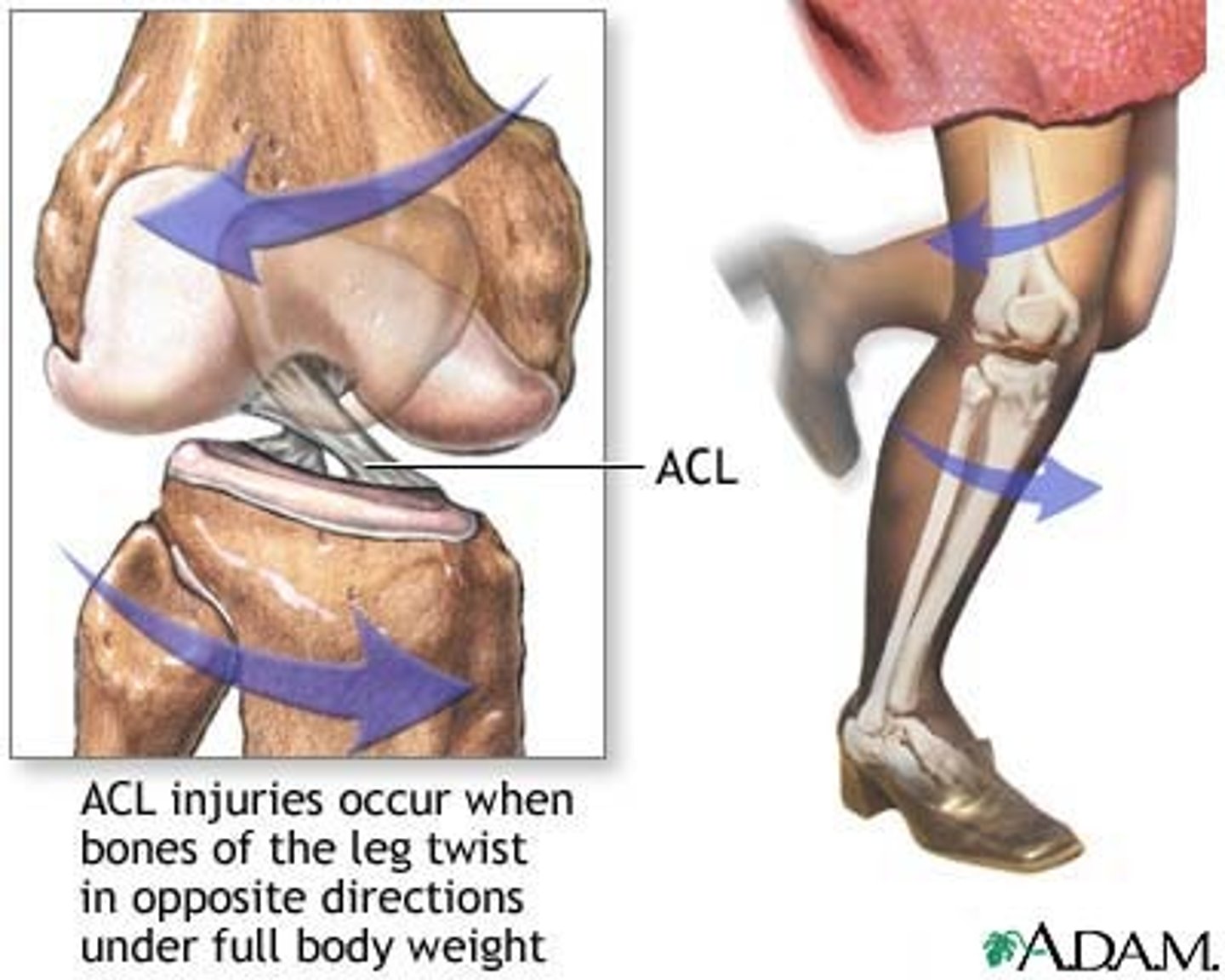<p>Usually caused when pivoting on a flexed knee</p><p>Often injured as athlete is attempting to change direction</p><p>Twisting of lower leg - popping sound</p><p>Injured during excessive hyperextension </p>