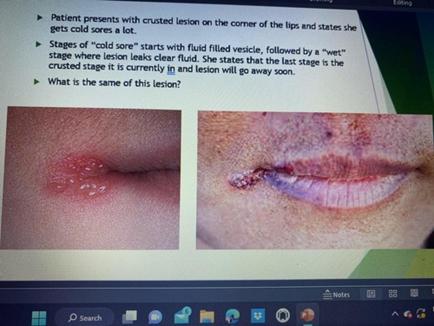 <p>Patients presents with crusted lesion on the corner of the lips and states she gets cold sores a lot.</p><p>Stages of cold sores starts with fluid filled vesicle, followed by a "wet" stage where lesion leaks clear fluid. She states that the last stage is the crusted state it is currently in and lesion will go away soon.</p>