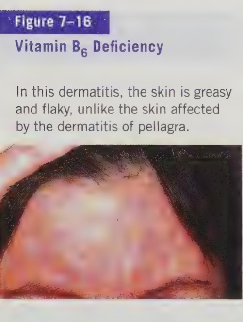 <ul><li><p>cause weakness, psychological depression, confusion, irritability, insomnia, anemia (small-celled), and greasy dermatitis</p></li><li><p>may also causes convulsions, and may weaken the immune system</p></li><li><p>some evidence suggest that low vitamin B6 intakes may be related to an increased incidence of heart disease</p></li></ul><p></p>
