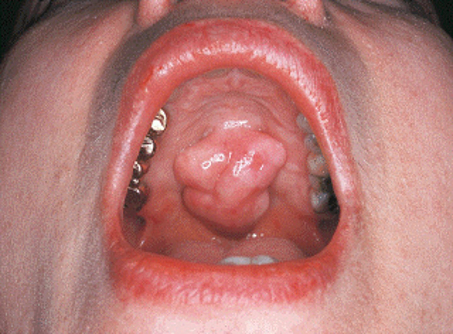 <p>lobulated.</p><p>This torus palatinus is lobulated (i.e., lobes that are fused together).</p><p>Bullous lesions contain serous fluid and resemble blisters.</p><p>A papule is a soft tissue lesion that is elevated above the surface of normal surrounding tissue.</p><p>A nodule is a palpable solid lesion found in soft tissue.</p>