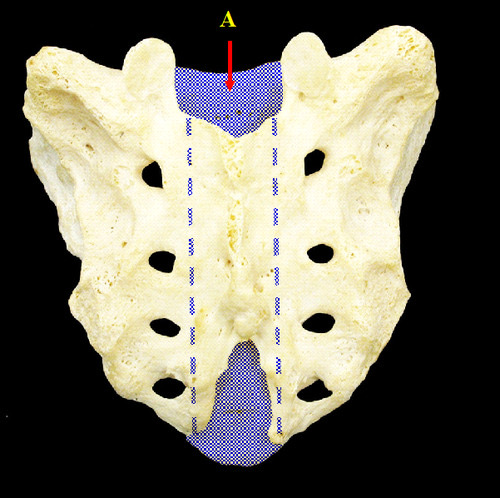 <p>continuation of the vertebral canal through the sacrum</p>