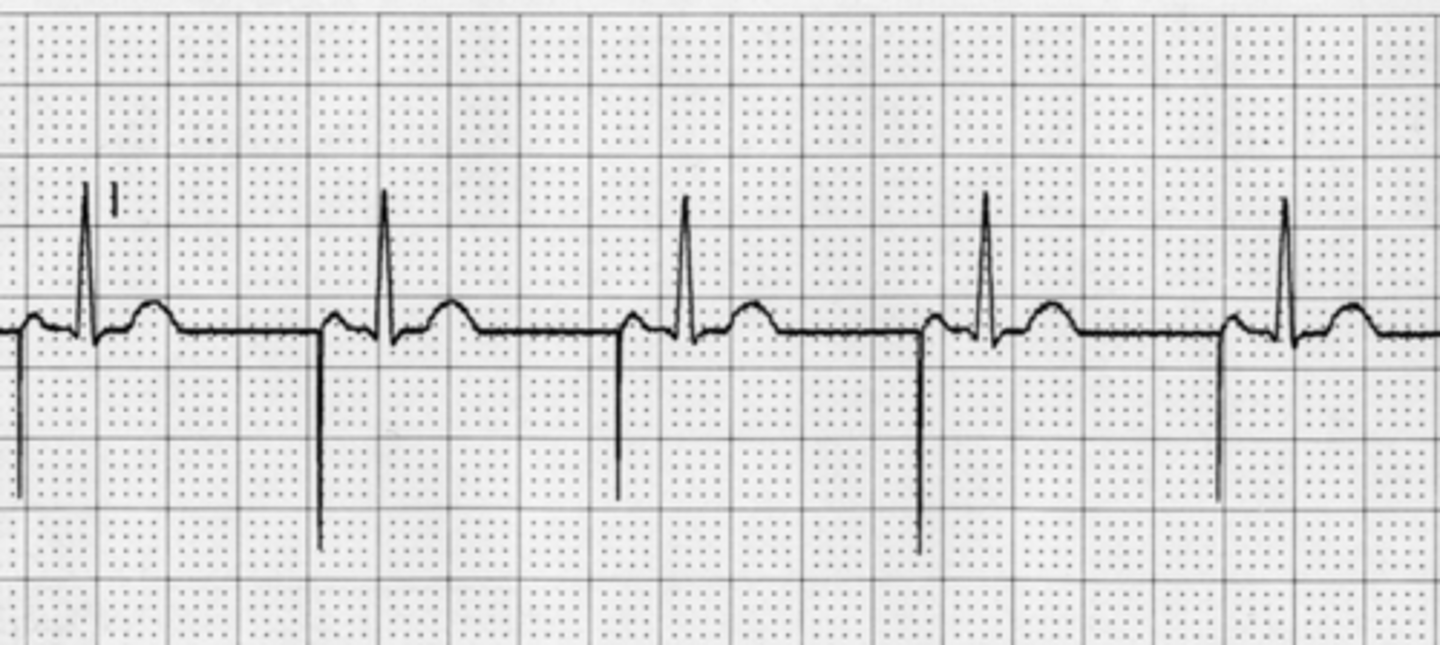 <p>Pacing is done within the atria. Firings are sent before the p wave.</p>