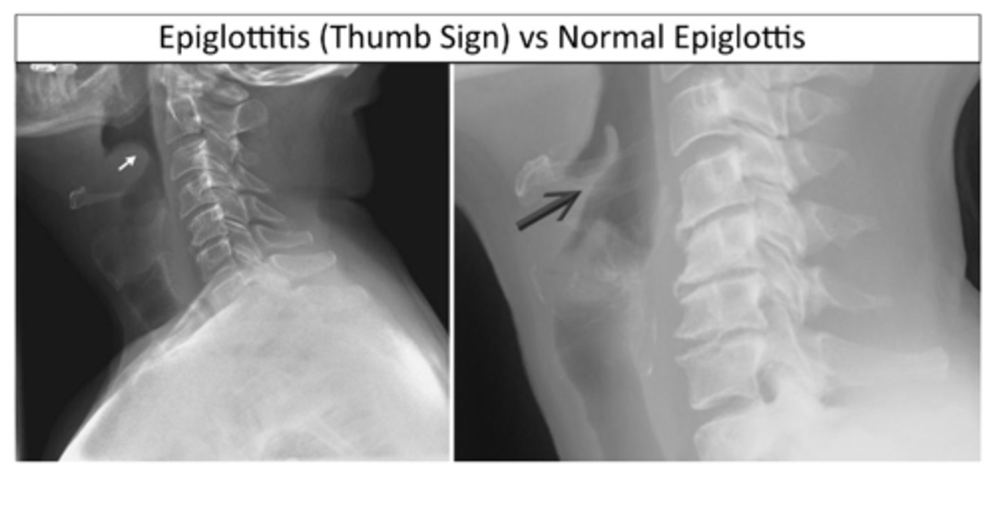 <p>Classic radiologic finding for epiglottitis (ID L or R)</p>