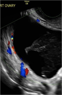 <p>Hemorrhagic cysts</p>