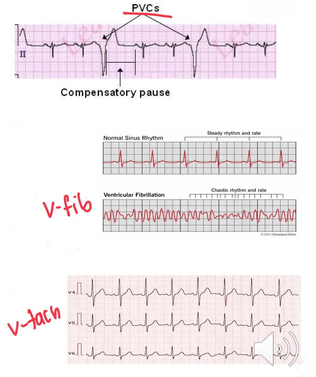 <ul><li><p><span><em>PVCs</em> (<strong><u>p</u></strong>remature <strong><u>v</u></strong>entricular <strong><u>c</u></strong>ontractions) -&gt; Common + no symptoms</span></p><ul><li><p><span>Caused: Exercise, caffeine, anxiety...can cause cardiomyopathy if frequent</span></p></li></ul></li></ul><ul><li><p><span><em>Ventricular fibrillation</em>(V fib) -&gt; Chaotic heart beats</span></p><ul><li><p><span>&nbsp;Deadly + Most common cause sudden cardiac death</span></p></li></ul></li></ul><ul><li><p><span><em>Ventricular tachycardia </em>(V tach) -&gt; HR&gt; 120, starts in ventricles,&nbsp;</span></p><ul><li><p><span>Caused: ischemic heart disease</span></p></li></ul></li></ul><p></p>