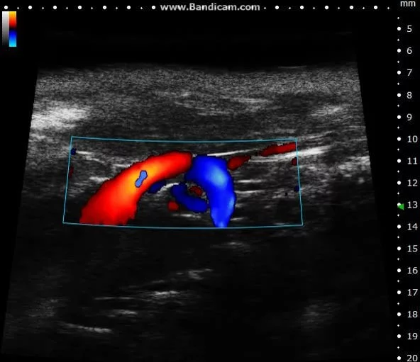 <p>Whats the direction of flow in this picture?</p><p>a. right to left</p><p>b. left to right</p><p>c. turbulent flow</p><p>d. cephalad to caudal</p>