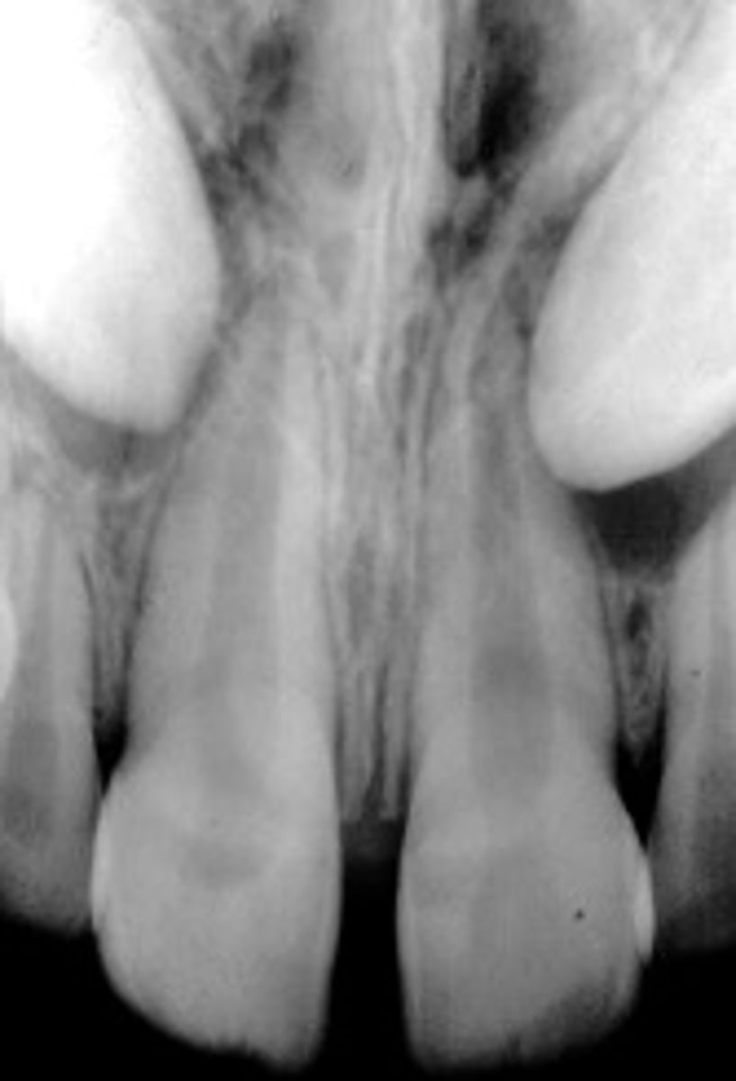 <p>how can you tell that this is a developmental sac and not a dentigetous cyst?</p>