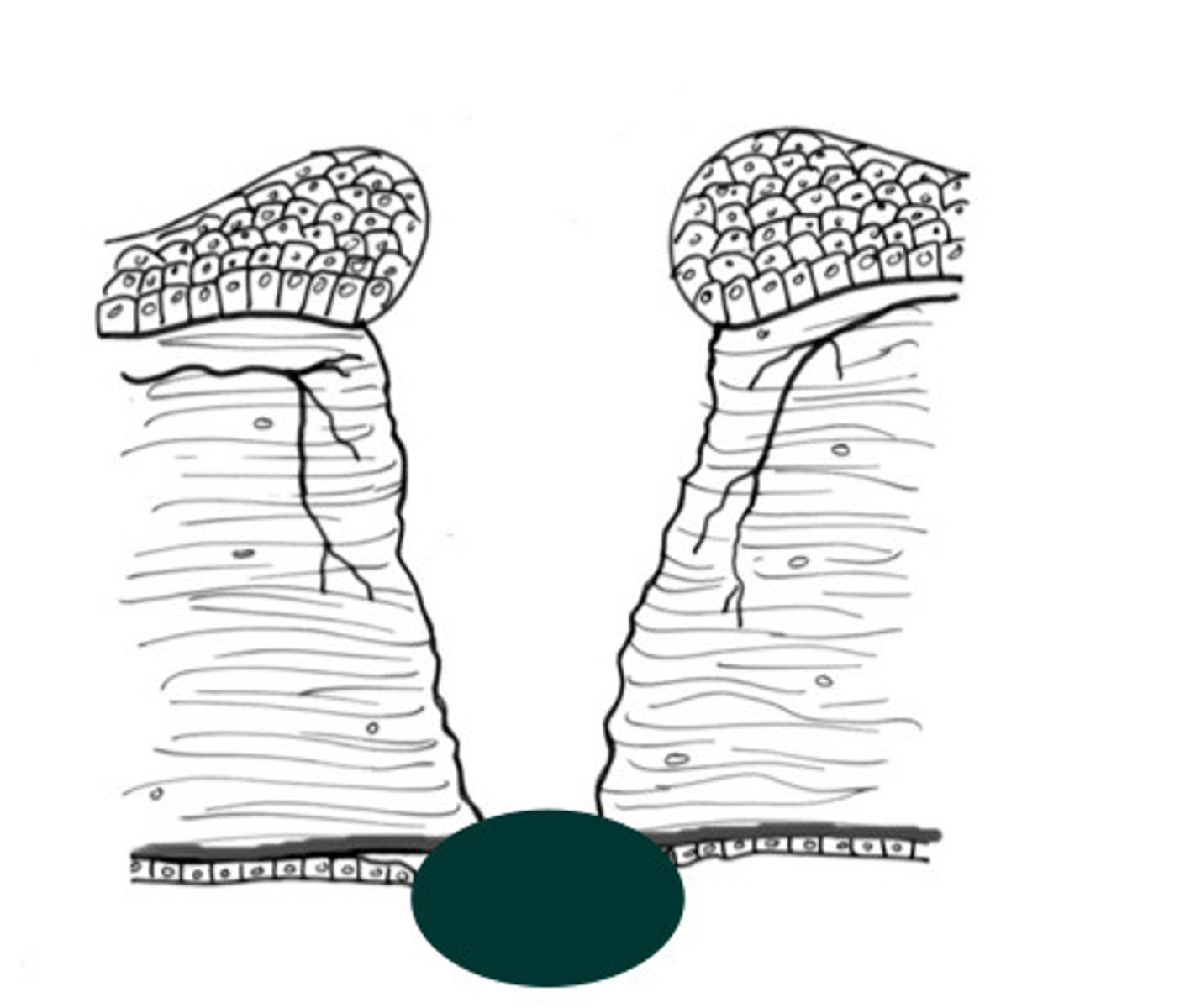 <p>Describe what type of cornea ulcer is happening here, where the eye plugs the hole in case of rupture?</p>