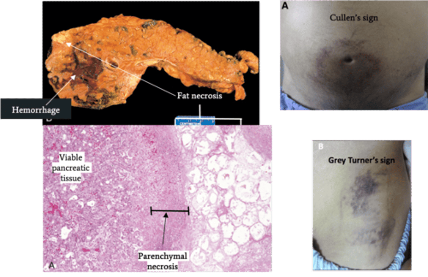 <p>Define Condition:</p><p>Acute inflammation of pancreas d/t autodigestion of pancreas by pancreatic enzymes that are prematurely activated</p><p>-Hx: ("I GET SMASHED")</p><p>&gt; Idiopathic</p><p>&gt; Gallstones (mostly FEMALES)</p><p>&gt; Chronic Excessive EtOH (mostly MALES) Consumption</p><p>&gt; Trauma</p><p>&gt; Steroids</p><p>&gt; Mumps</p><p>&gt; Autoimmune</p><p>&gt; Scorpion Sting</p><p>&gt; Hypercalcemia/Hypertriglyceridemia</p><p>&gt; Recent ERCP</p><p>&gt; Drugs (Sulfa, Protease Inhibitors)</p><p>-Path:</p><p>&gt; Alcohol:</p><p>&gt;&gt; Increased Pancreatic Exocrine secretion ==&gt; PROTEIN PLUGS</p><p>&gt;&gt; Increased contraction of Sphincter of Oddi (prevents enzymes from leaving pancreas)</p><p>&gt;&gt; Induces oxidative stress in acinar cells (membrane damage)</p><p>&gt;&gt; May deliver proenzymes to lysosomal compartment ==&gt; Intracellular activation of enzymes</p><p>&gt; HyperTGs (&gt;1000): TGs hydrolyzed into FFAs in pancreas --&gt; Acinar cell injury</p><p>&gt; Microvascular leakage from cytokines &amp; Inflamm mediators ==&gt; EDEMA/Hypovolemia --&gt; SHOCK/Organ Fail</p><p>&gt; Lipase ==&gt; FAT NECROSIS</p><p>&gt; Proteolytic destruction of pancreatic parenhcyma/blood vessels --&gt; INTERSTITIAL HEMORRHAGE</p><p>-Sx/PE:</p><p>&gt; Mild/Self-Limiting Epigastric Abdominal Pain</p><p>&gt; EMERGENT = Constant, INTENSE Epigastric Pain radiating to back</p><p>&gt;&gt; Nausea/Vomiting</p><p>&gt;&gt; Skin Changes</p><p>&gt;&gt;&gt; Cullen's Sign = Ecchymoses/Bruising around umbilicus</p><p>&gt;&gt;&gt; Grey Turner's Sign = Ecchymosis in 1 or both flanks</p><p>-Dx:</p><p>&gt; Labs:</p><p>&gt;&gt; LIPASE = MOST SENSITIVE/SPECIFIC (elevated for 8-14 days)</p><p>&gt;&gt; Amylase = normal by 3-5 days</p><p>&gt;&gt; Lipase &amp; Amylase elevated (3x ULN) 4-12 hrs after pain</p><p>&gt; Gross:</p><p>&gt;&gt; Fat Necrosis</p><p>&gt;&gt; Hemorrhage</p><p>&gt; Biopsy:</p><p>&gt;&gt; Interstitial Edema</p><p>&gt;&gt; Fat Necrosis</p><p>&gt;&gt; Hemorrhage</p><p>&gt;&gt; Parenchymal Necrosis</p><p>-Tx:</p><p>-Prog:</p><p>&gt; POOR if progresses to EMERGENT</p><p>&gt; Acute Resp Distress Syndrome (ARDS)</p><p>&gt; DIC (inflammation/endothelial injury --&gt; consumption of clotting factors)</p><p>&gt; Sepsis</p><p>&gt; Pancreatic pseudocyst</p><p>&gt; Hypocalcemia - POOR PROGNOSTIC FACTOR (precipitation of Ca soaps w/ fat necrosis)</p>