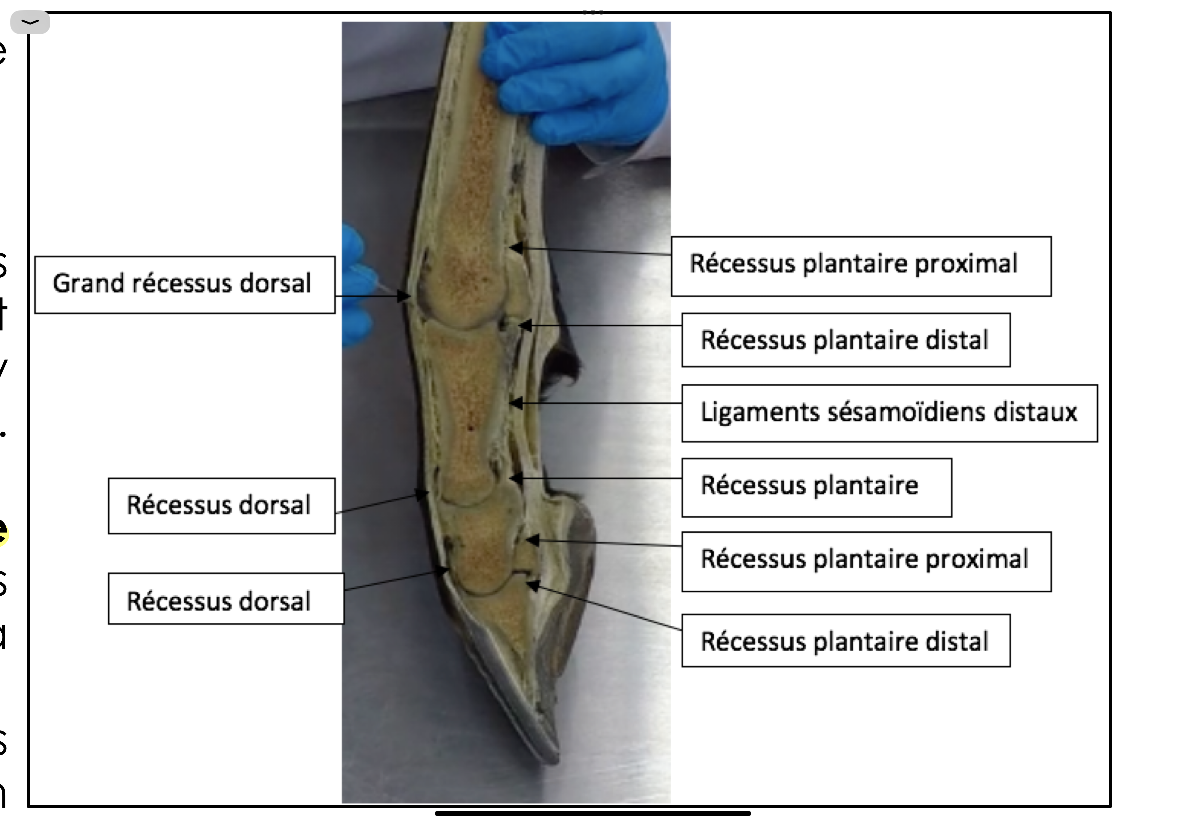<p>L’articulation interphalangienne distale est très importante à connaître car beaucoup de boiteries sont situées à ce niveau. Il y a 3 os en contact : P2, P3 et l’os naviculaire.</p><p>- La synoviale articulaire présente 3 récessus :</p><p>‣ Un récessus dorsal</p><p>‣ Un récessus palmaire / plantaire proximal</p><p>‣ Un récessus palmaire / plantaire distal</p><p>- Ponction articulaire:</p><p>‣ Ne se fait pas dans les récessus palmaires: Ils sont situés profondément dans le sabot. En effet, dans le sabot il y a la moitié de P2, P3 et l’os naviculaire. Il est impossible de les atteindre.</p><p>‣ La ponction se réalise donc dans le récessus dorsal: Il remonte de plusieurs centimètres au-dessus du niveau de la couronne.</p><p>‣ Repères pour la ponction: Recessus palpable → Site un peu mou où on peut enfoncer le doigt. Si le cheval a une pathologie de l’articulation interphalangienne distale, il y a production de plus de liquide synovial (inflammation) et gonflement plus important à ce niveau qu’on pourra palper.</p>