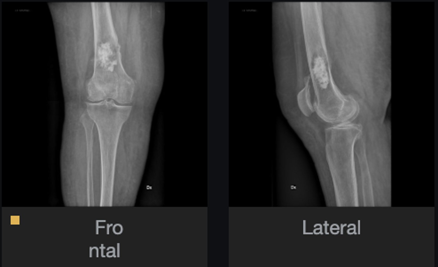 <p>These x-rays were taken 3.5 years later:</p><p>- List at least 3 new findings</p><p>- At this point, is this aggressive or non-aggressive?</p>