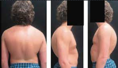 Scheuermann’s disease