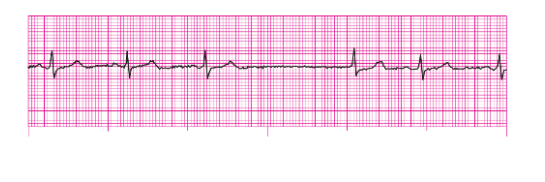 <p>Rhythm of Junctional escape beat?</p>
